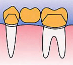 固定式義歯